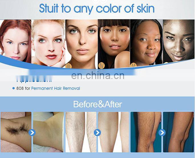 2020 Hottest !!! hair removal 808nm diode laser / laser alexandrite / 808nm permanent hair removal