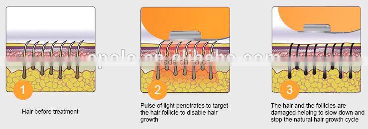 Apolomed factory direct sell floor standing depilation ipl shr with 2 handpiece(IPL SHR + E-light)