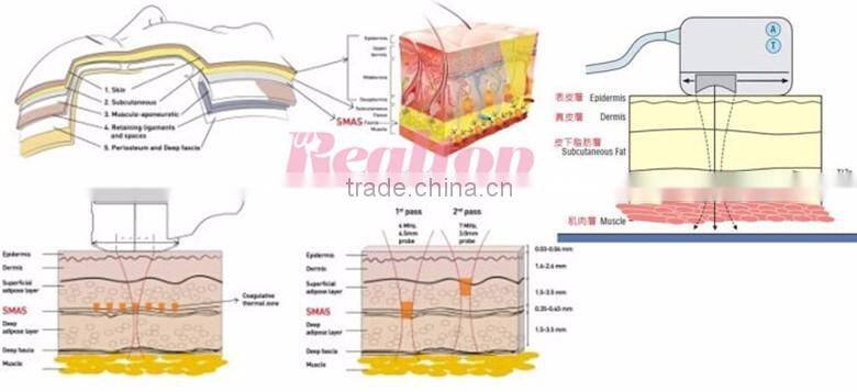 Portable hifu machine high intensive focus ultrasonic knife facial care skin tightening ultra age hifu face lift machine