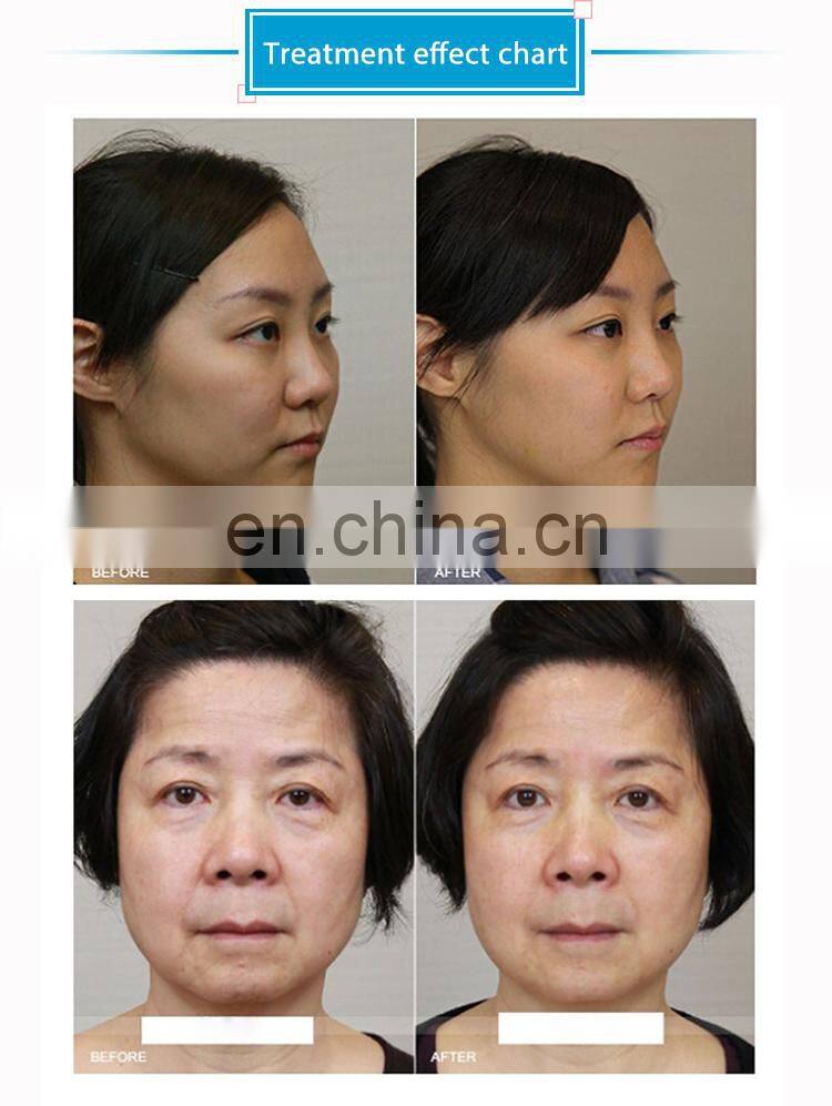 2019 New Arrivals Ultrasound Women's Private Vaginal Rejuvenation Beauty&Personal Care