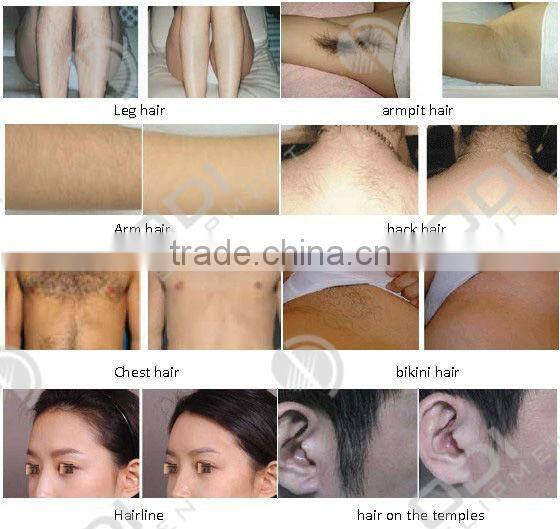 Hot!! Laser removal hair with painless and permanent hair removal treatment (LS808)