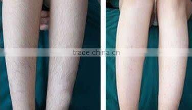 New 808nm diode laser hair removal machine/ hair removal speed 808