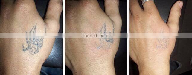 Taibo ODM OEM e-light ipl rf+nd yag laser/E-light +RF +Q-switch nd yag laser tattoo removal hair removal machine 3in1