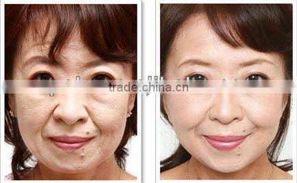 1Mhz Monopolar RF skin tighten beauty machine