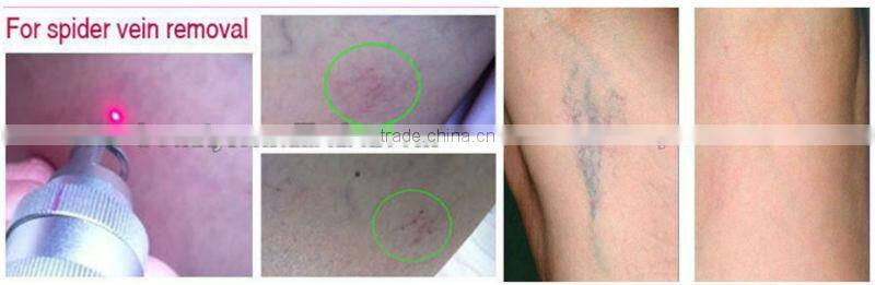 Personal Pain Free Nd Yag laser hair remover and onychomycosis removal