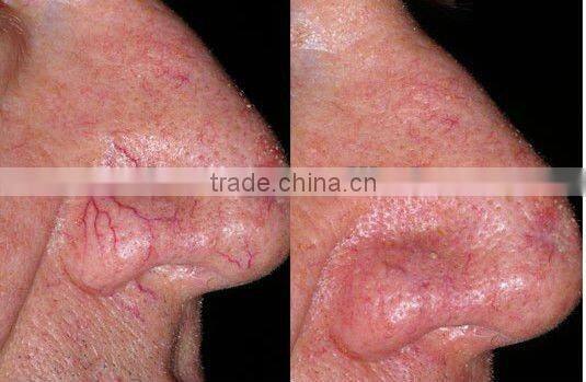 beauty studio nail fungus treatment laser hair removal device-P003