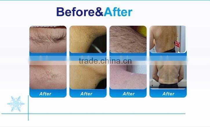 fast hair removal new non channel diode laser