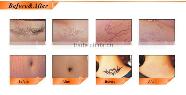 permanent hair reduction equipment with ipl laser