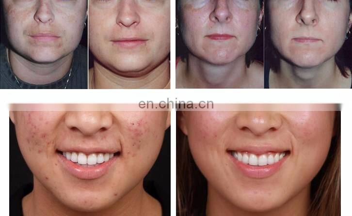 Multifunction 5 in 1 skin bella power peel microdermabrasion machine