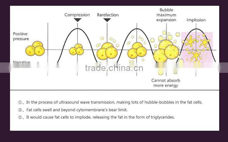 2016 ultrashape hifu body slimming machine / liposonic machine / ultrasonic ultrasound liposuction equipment for weight loss