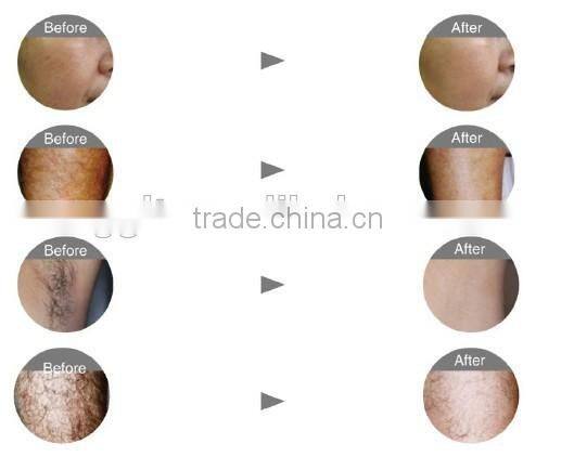 2015 free shipping 808nm diode laser hair removal device