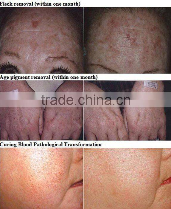 CE approval QS ND.YAG e light IPL+bipolar RF laser beauty machine for hair,fleck,pigment,tattoo removal and skin rejuvenation