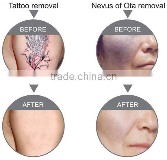 Super Fast Color Touch Screen Logo Customized 10HZ Tattoo Removal Machine Suppliers