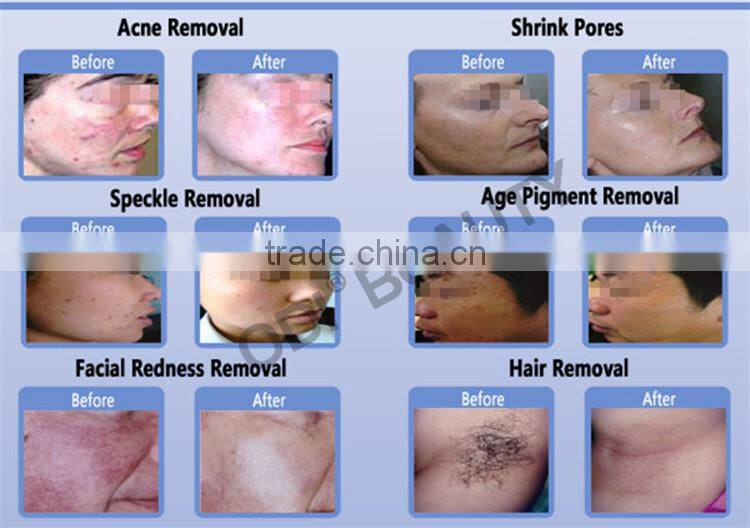 OPT ipl hair removal equipment with 80.000 shots ipl flash lamp