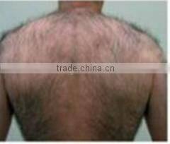 New Product Salon Use Laser Hair Removal Laser Hair Removal E-light IPL