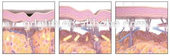 2016 Newest Portable HIFU ultrasound hifu body slimming beauty machine