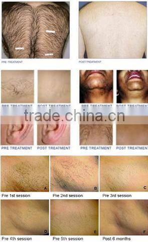 1800w diode laser marking machine for permanent hair removal