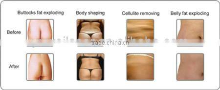 Best effective machines cavitation figure shaping body slimming fat melting slimming machine ultrasonic cavitation