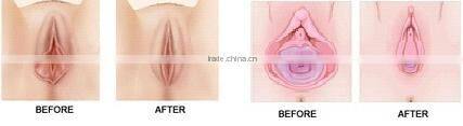 2016 hotselling! fractional CO2 vaginal rejuvenation laser machine