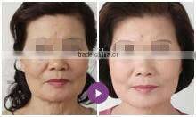 2in1 Skin Rejuvenation Hair Removal System IPL Beauty machine