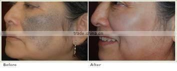 Beauty equipment tattoo removal machine multifunction Q Switched Nd Yag Laser device