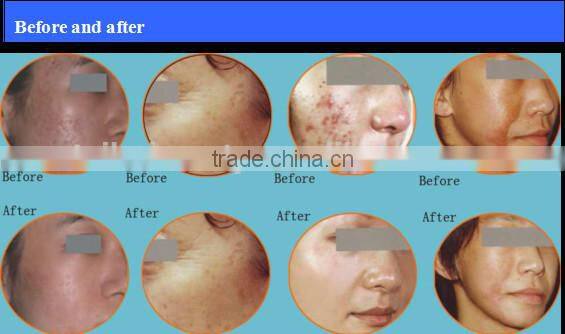 Taibo beauty Fractional Co2 Laser Surgical Products vaginal applicator