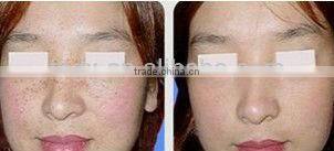 Portable Hair Removal IPL Beauty Machine