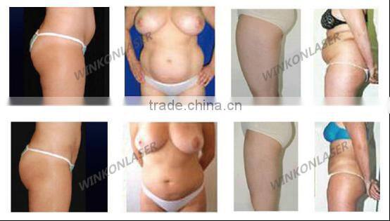 vacuum cavitation rf machine / rf cavitation / ultrasonic cavitation