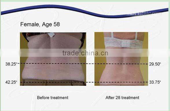 2016 weight loss slimming 3 cryo handles cryolipolysis