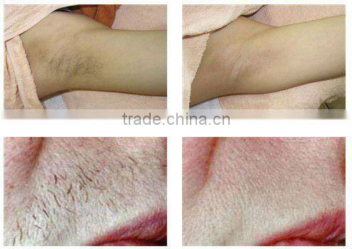 2012professional laser hair tattoo removal machine P003