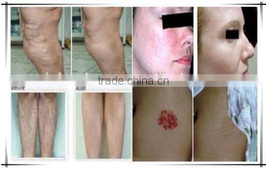 body hair removal / laser helmet hair / laser hair extension machine