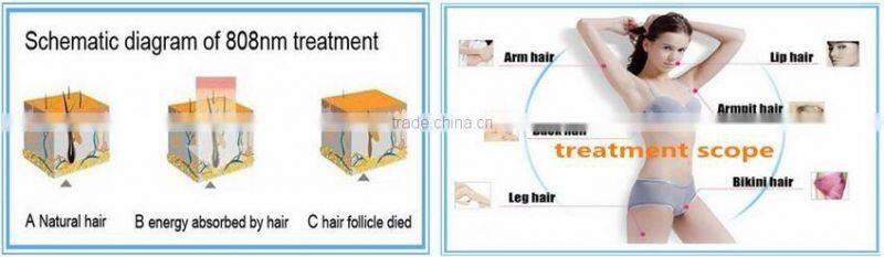 distributor wanted europe 808nm diode laser hair removal speed 808