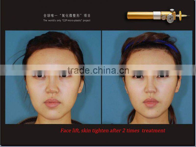 fast beauty device!!!CDT CO2 carboxy equipment/carboxy therapy machine