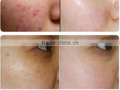 acne scar removal laser CO2 Laser high quality and best price fractional c02 laser acne treatment