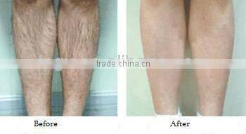 2013 new design high power 808nm Diode Laser permanent hair removal machine