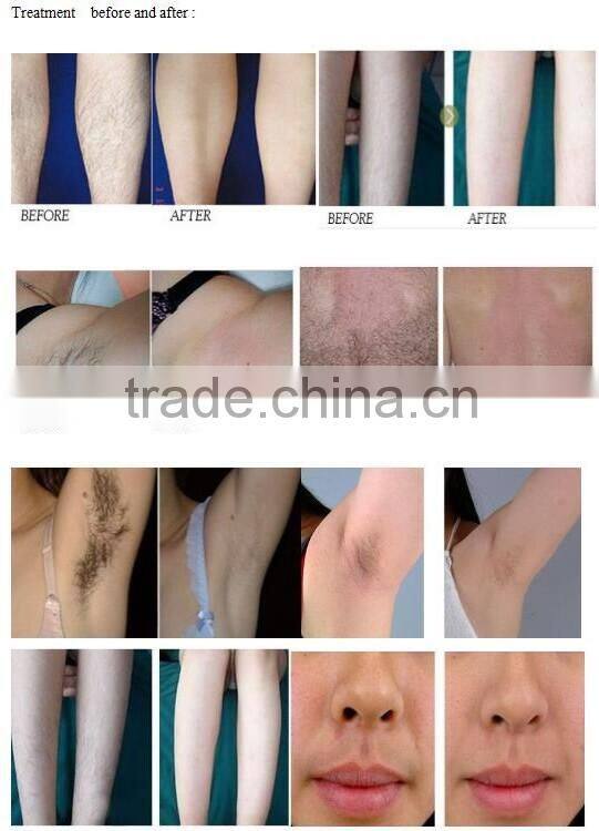 Best professional 808 diode laser hair removal machine with Germany bars