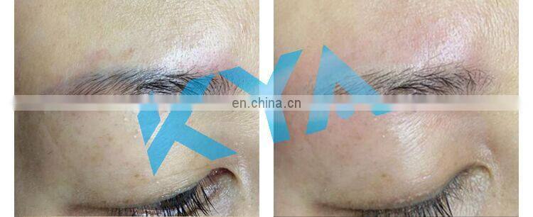 HOT Tattoo Removal Laser Machine 1064nm 532nm 1320nm Q Switched Nd Yag Laser Non Invasive Eyebrow Pigment Removal Instrument