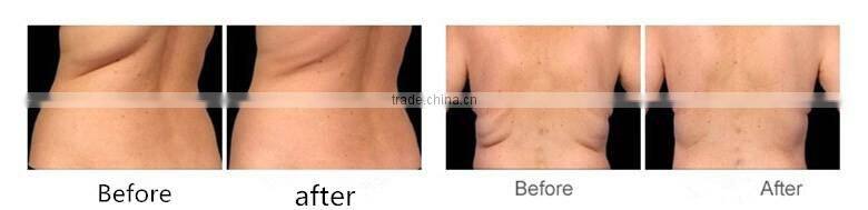 hot cheap price cryo cool device freezing fat cell in 2016