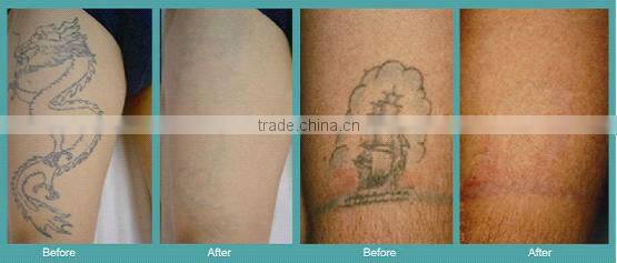 Hottest in France 16 languages for choose , Nd:Yag laser for tattoo removal, dermal pigmentation treatment with CE approval