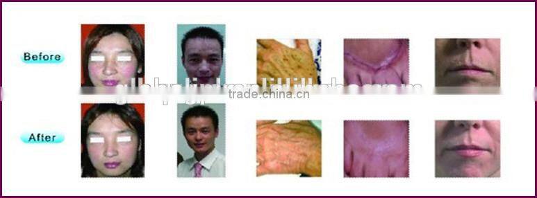 Laser Beauty machine best price pigment remover vagina tightening machine