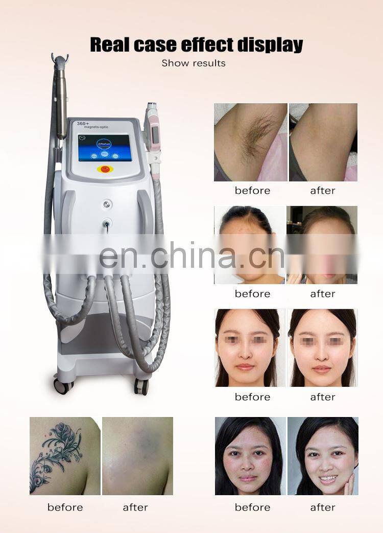 Multifunction 360 Magneto Optical System +755 nm Picosecond Laser + RF Laser Hair Removal 3 in 1