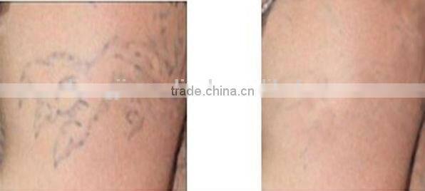 Zhengjia medical skin care machine/ facial tightening equipment with CE