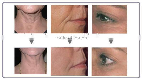 Face Lifting radio frequency machine cost/skin lifting/lifting skin with Fractional RF