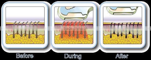 2014 SHR IPL fast epilator System HS-350E