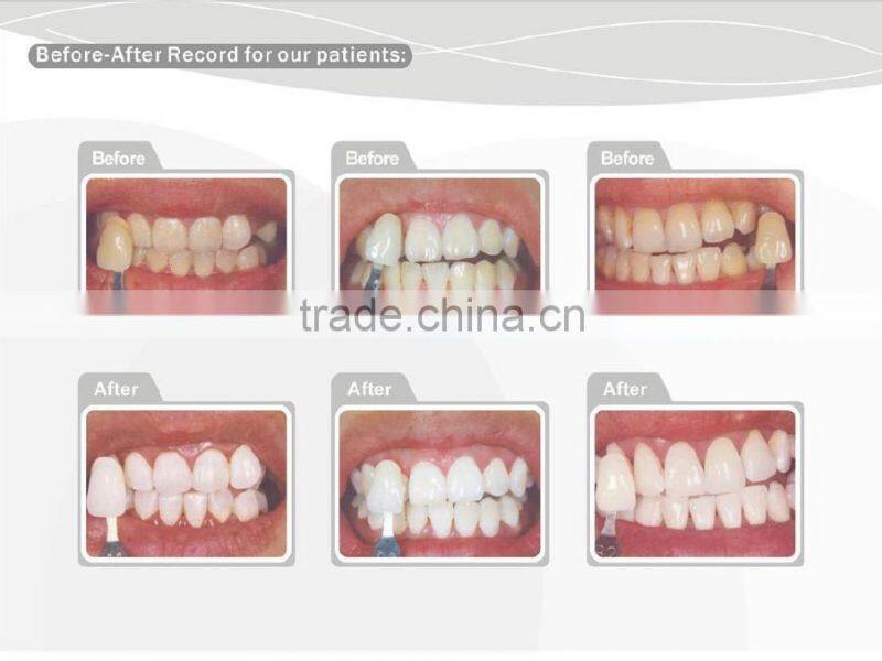 Teeth whitening kit for teeth whitening lamp