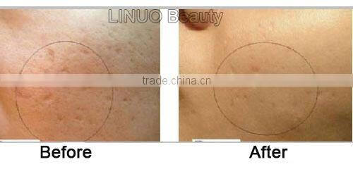 2014 micro needle derma roller (Professional ,Effective !!!!!!!!!!!!)