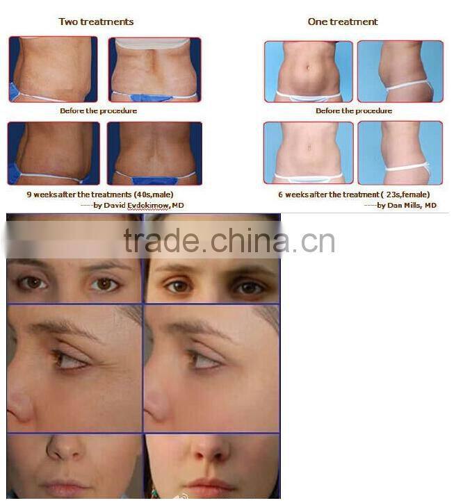 Liposuction Cavitation RF Slimming Machine Vacuum Radio Frequency Tripolar Multipolar Weight Loss Cellulite Removal Equipment