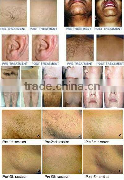 High quality portable personal ipl laser hair removal machine for hair removal