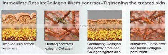 RF Skin Rejuvenation Vacuum Cavitation System