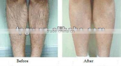 New Style ipl/rf hair removal machine with two handles